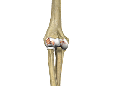 Elbow Arthritis