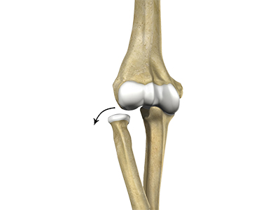 Elbow Dislocation