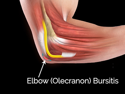 Elbow (Olecranon) Bursitis