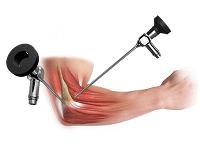 Elbow Surgery