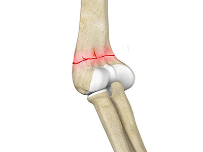 Fracture Care