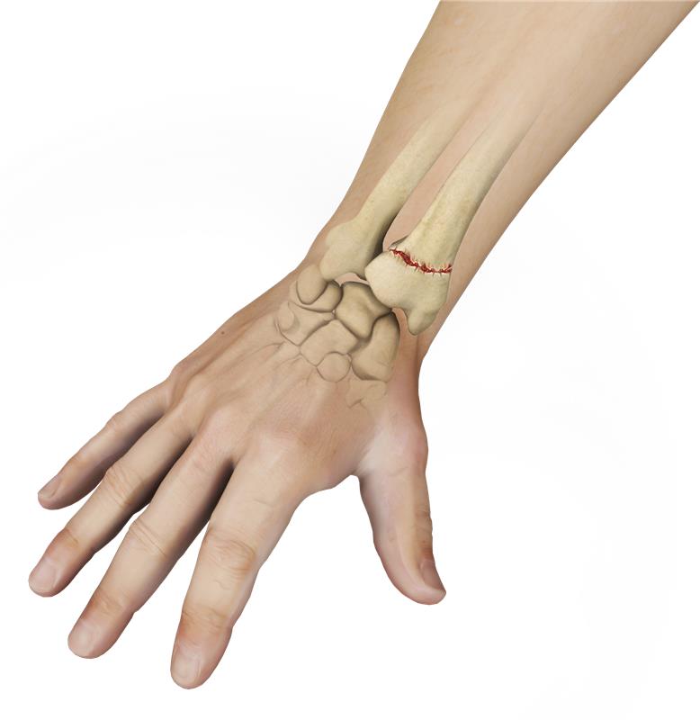 Fracture Care Icon