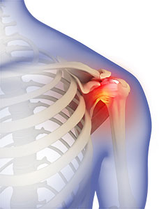 Frozen Shoulder