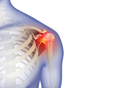 Frozen Shoulder