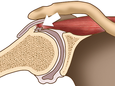Internal Impingement of the Shoulder