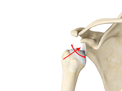 Multidirectional Instability of the Shoulder