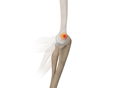 Posterior Impingement of the Elbow