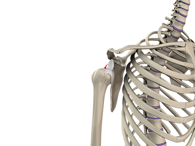 Shoulder Dislocation