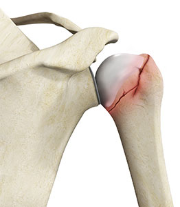 Shoulder Fracture