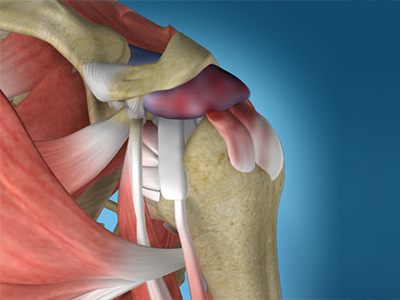 Shoulder Impingement