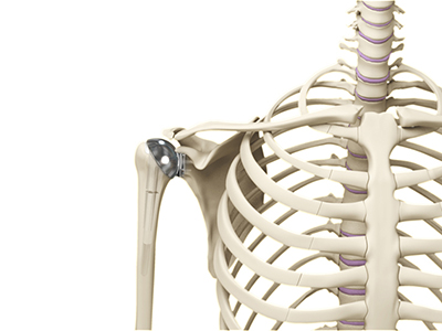 Shoulder Joint Replacement