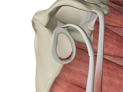 Shoulder Labral Tear
