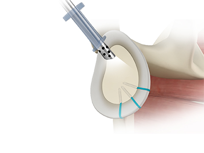 Shoulder Reconstruction Surgery