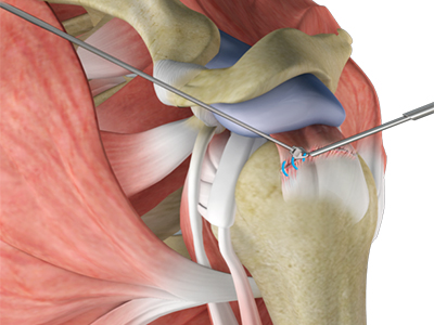 Shoulder Stabilization
