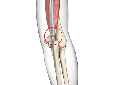 Triceps Injuries