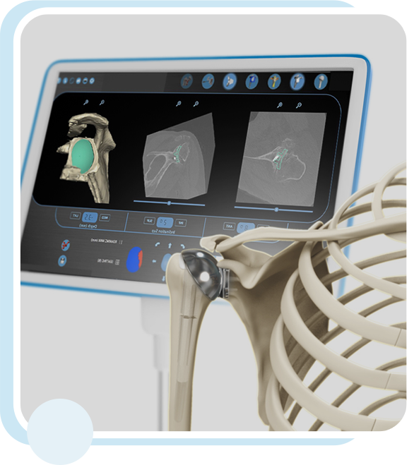 Guided Accuracy for Shoulder Surgery