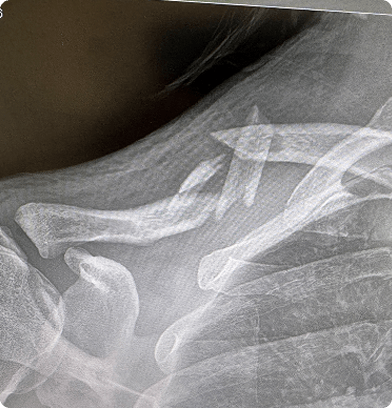 Picture of Broken Rib