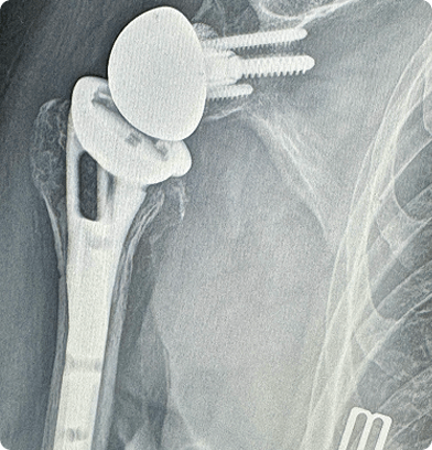 Picture of Repaired Shoulder