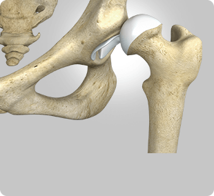 Traumatic Hip Dislocations