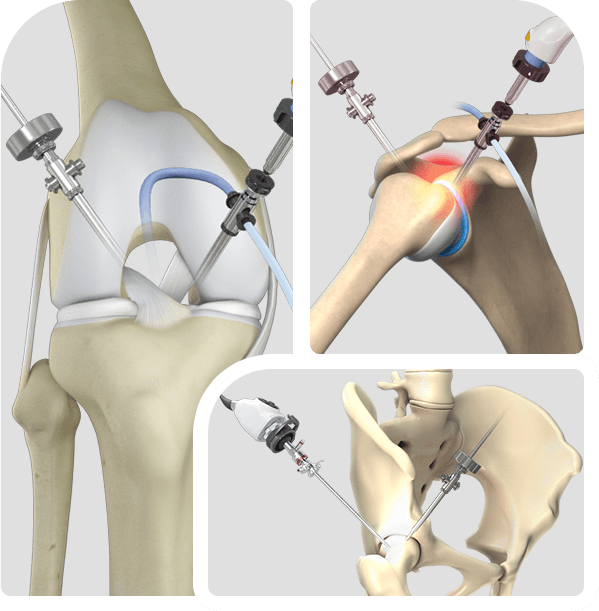 Minimally Invasive Arthroscopic Surgery