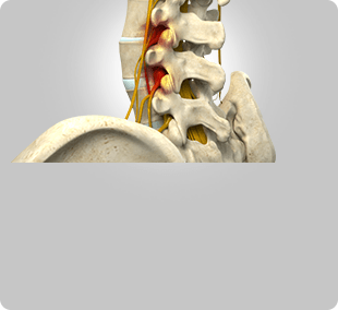 Spine Surgery