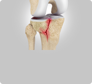 Tibial Plateau Fractures