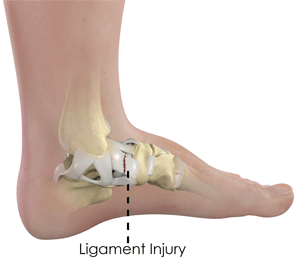 Ankle Ligament Injury pic