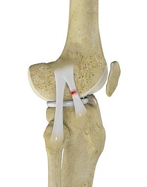 Anterolateral Ligament (ALL) Reconstruction pic