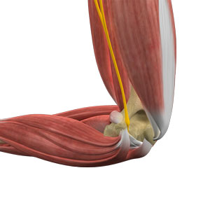 Cubital Tunnel Syndrome (Ulnar Nerve Entrapment) pic
