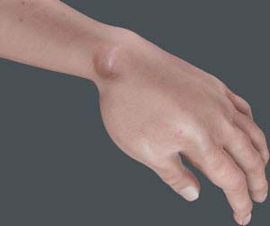 Ganglion Cyst pic