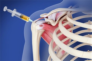 Orthobiologics Treatment for Shoulder pic