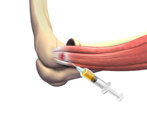 Platelet-Rich Plasma (PRP) for the Elbow  pic