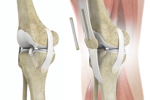 ACL Reconstruction with Quadriceps Autograft pic