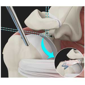 Arthroscopic Superior Capsular Reconstruction pic