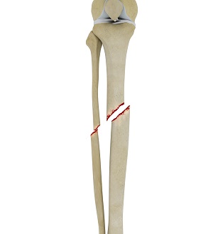 Tibial Shaft Fracture pic