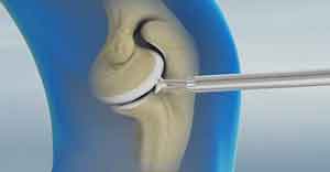 Arthroscopic Debridement of the Elbow pic
