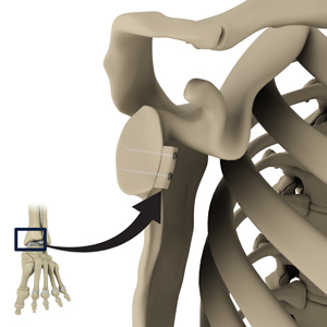 Distal Tibial Allograft Glenoid Reconstruction pic