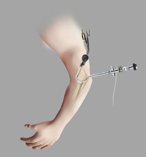 Elbow Arthroscopy pic