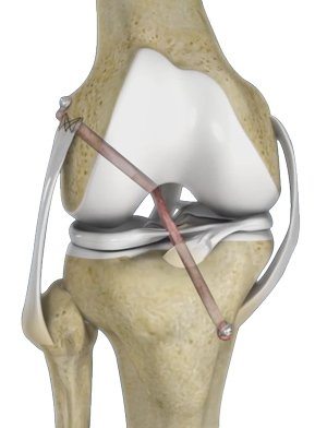 Knee Ligament Reconstruction pic