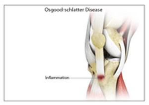 Osgood Schlatter Disease pic
