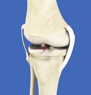 Pediatric ACL Tears pic