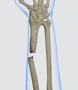 Pediatric Forearm Fracture pic