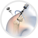 Arthroscopic Shoulder Surgery