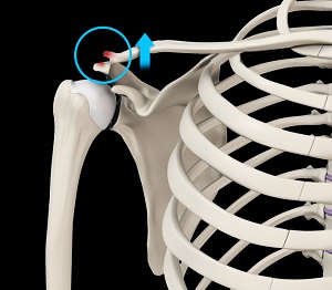 Acromioclavicular Joint Dislocation (Shoulder Separation) pic