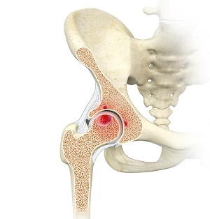 Acetabular Subchondral Cysts pic