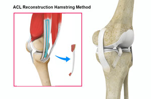ACL Reconstruction with Hamstring pic