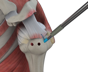 Arthroscopic Surgery pic