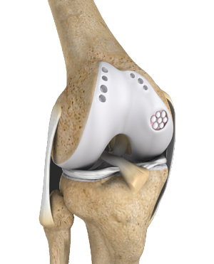 Cartilage Restoration pic