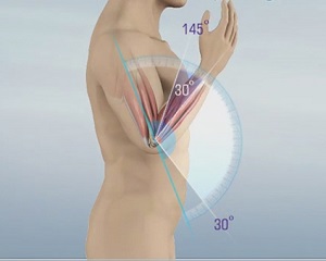 Elbow Contracture pic
