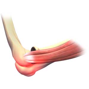Elbow Sprain pic